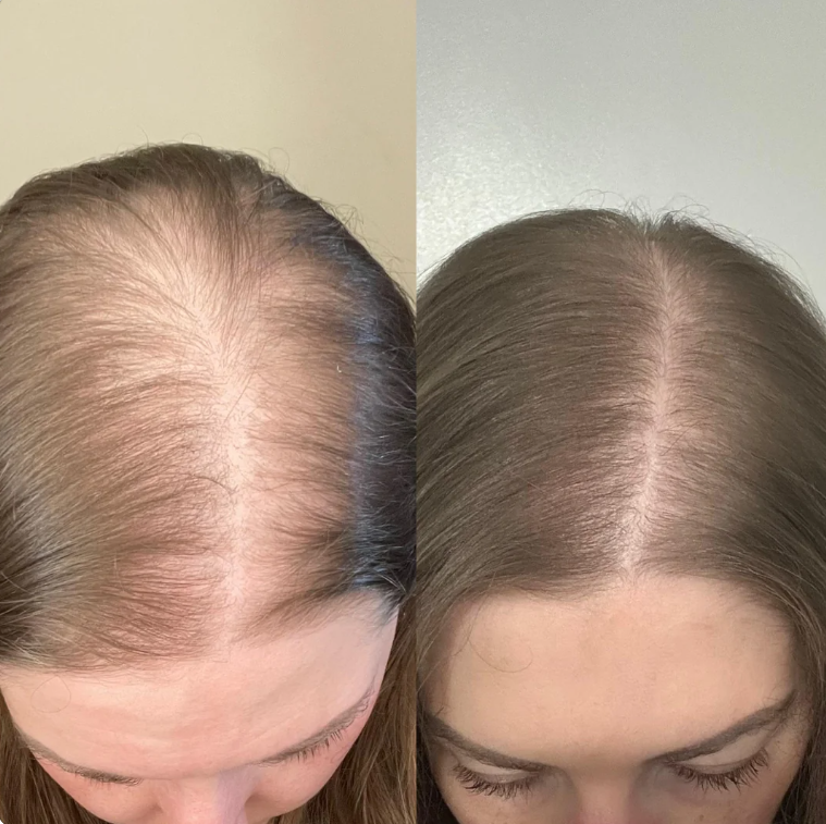 Rachel K., 49 before and after results